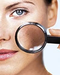 Multi cred ca daca iti zgarii un semn de mama, risti sa faci cancer. S O S Prea Multe Alunite