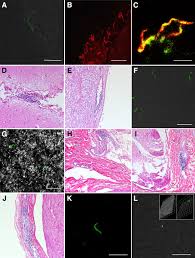 Late Disseminated Lyme Disease The American Journal Of Pathology
