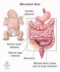 Image result for Intestinal Atresia