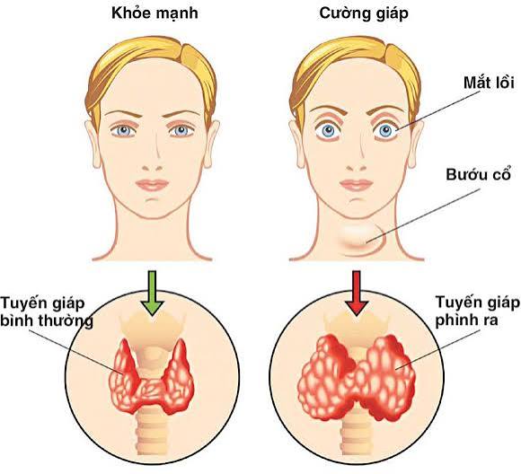 Bệnh lý tuyến giáp phổ biến, dưới đây là 11 dấu hiệu cảnh báo