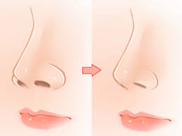 Maybe you would like to learn more about one of these? What Are The Different Types Of Rhinoplasty Erufu Care