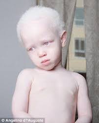 Bazen yüzü, kirpikleri, saçları tamamı ile bembeyaz olan kişiler görmekteyiz. Stunning Photo Series Features People With Albinism Albinism Pale Skin Albino