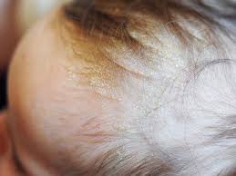 Image result for white scabs on the head in children