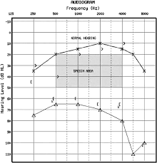 Image result for Audiogram