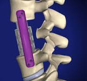 Vertebral Body Replacement (VBR) - Willis Knighton Health ...