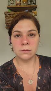 Hello ladies! I had saline breast implants for 16 years. 8 months after I  got them in a started having weird unexplained issues