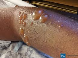 Image result for Pemphigoid