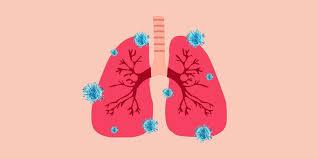 Less common histologic appearances of exocrine pancreatic cancers include giant cell carcinoma, adenosquamous carcinoma, microglandular. Covid 19 Le Syndrome De Detresse Respiratoire Aigue Une Urgence Medicale Marie Claire