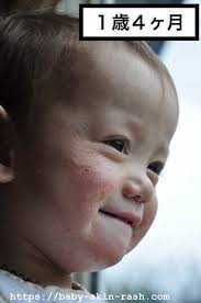 乳児湿疹は自然治癒する いつ消える 実際の症例を写真付きで紹介 ゾンビと呼ばれた赤ちゃん 湿疹 症例 自然療法