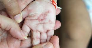 Kupas kulit kencur sampai bersih dan dikunyah. Waspada Scabies Pada Anak Penyakit Kulit Akibat Kutu Hewan Popmama Com