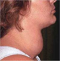 Physical Signs of Malnutrition