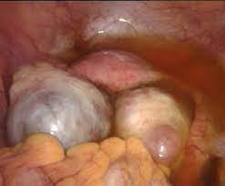They can vary in size from one or two centimetres to ten or more centimetres (pic. Mic Zentrum Frankfurt Operationen Endometriose