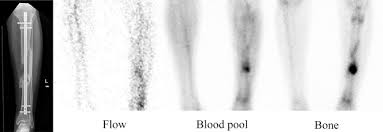 Image result for Osteomyelitis Bone Scan