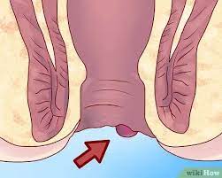 كيفية التعرف على أعراض البواسير صور توضيحية wikihow