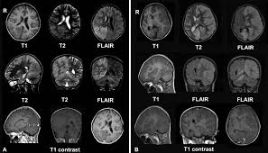 Encephalitis is an infectious or inflammatory disorder of the brain manifest by fever and headache and associated with a depressed level of consciousness, an altered mental status (confusion, behavioral abnormalities), focal neurologic deficits, or new onset seizure activity. Encephalitis Causes Signs Symptoms Clinical Diagnosis