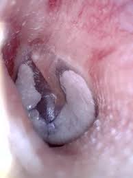 Image result for Myringosclerosis