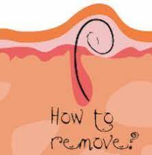 Pulling ingrown hairs out using tweezers is the fastest, most direct way to remove them. Pin On Hair Remove