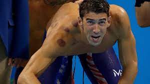 Phelps showed snippets of his cupping therapy on his instagram as well as. Why Are So Many Olympians Covered In Large Red Circles Bbc News