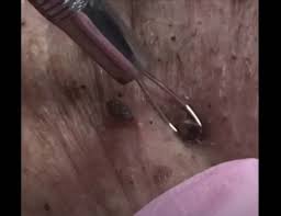 This video features a man whose ingrown beard hair never seems to end. Massive Ingrown Hair Removal Youtube Archives New Pimple Popping Videos