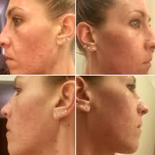 Returning patients signing up for their service again are not eligible for a refund. Curology Review For Acne 5 Week Results