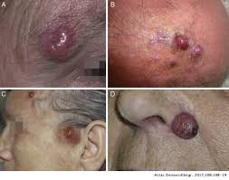 Merkel cell carcinoma at a glance. Update On Merkel Cell Carcinoma Epidemiology Etiopathogenesis Clinical Features Diagnosis And Staging Actas Dermo Sifiliograficas