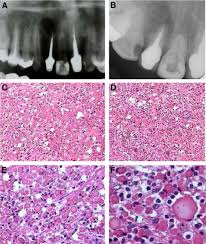 The russell body is characteristic of the distended endoplasmic reticulum. Russell Body Apical Periodontitis An Unusual Case Report Oral Surgery Oral Medicine Oral Pathology Oral Radiology And Endodontics