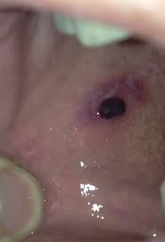 In most cases, the blister may resemble a pimple which becomes very painful when touched or felt with hand. Angina Bullosa Haemorrhagica Wikipedia