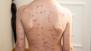 Chickenpox is a highly contagious infection that causes an itchy, spotty rash. Cara Merawat Luka Cacar Air Pada Anak Kumparan Com