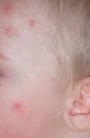 Bed bug bites will most commonly occur on the arms, neck, or trunk of the body, says gibb, although they'll bite. Bed Bug Bites On Baby Baby Viewer