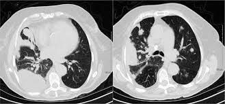 Thoracic computed tomography (ct) showed a large heterogeneous pleural mass . Cureus Malignant Pleural Mesothelioma Biphasic Type An Unusual And Insidious Case Of Rapidly Progressive Small Blue Cell Tumor
