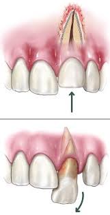 Image result for Tooth Avulsion
