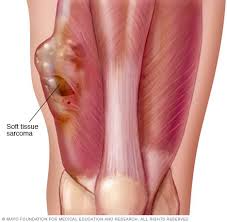 Soft Tissue Sarcoma Sarcoma Cancer Sarcoma Childhood Cancer