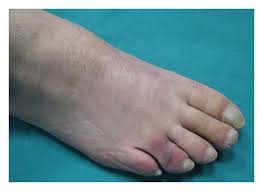 Skin cancer pictures by type. Granular Cell Tumor Of The Toe A Case Report