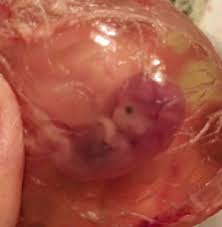 What causes miscarriage at 6 months