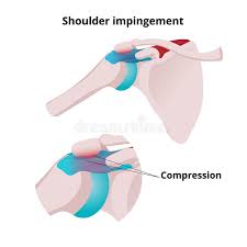 The long head biceps tendon travels through the shoulder joint making it more prone to injury such as a partial tear, rupture. Shoulder Tendon Stock Illustrations 524 Shoulder Tendon Stock Illustrations Vectors Clipart Dreamstime