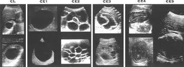 2 a ct imaging of type 3 cystic hydatid cyst with exophytic distension from the left lobe of the liver, compressing the stomach posteroinferiorly and operative figures of partial pericystectomy in this case (b); Expert Consensus For The Diagnosis And Treatment Of Cystic And Alveolar Echinococcosis In Humans Sciencedirect