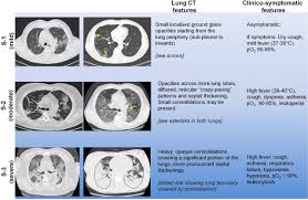 It was first identified in december 2019 in wuhan,. A Quantitative Lung Computed Tomography Image Feature For Multi Center Severity Assessment Of Covid 19 Medrxiv
