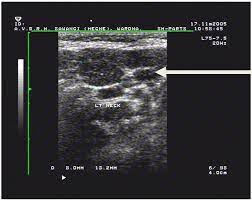 An ultrasound can occasionally identify a mass as ovarian cancer but should not be used to rule out ovarian cancer if a mass is not detected a protocol is put in place, depending on the specific features of the mass and the doctor's approach, but an ultrasound cannot outright detect, with. Local Metastasis In Head And Neck Cancer An Overview Intechopen