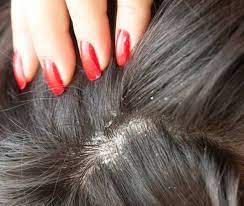 Firstly you need to heat 2 tablespoons of coconut oil and mix it equally with some mixture of lemon juice. How To Stop Hair Loss Due To Dandruff