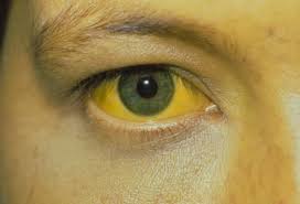 Image result for hepatitis symptoms