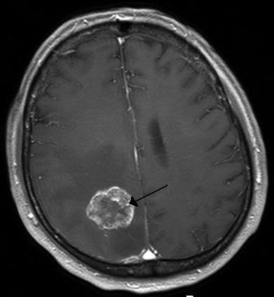 Tumor cerebral – Wikipédia, a enciclopédia livre