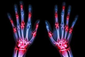 Flare Responsive Hydrogel Developed To Treat Arthritis