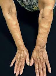 Scielo Brazil Dercum S Disease A Rare And Underdiagnosed Disease Dercum S Disease A Rare And Underdiagnosed Disease