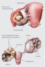 Bei endometriose wächst gebärmutterschleimhaut außerhalb der gebärmutterhöhle. Endometriose Rathaus Apotheke Abstatt