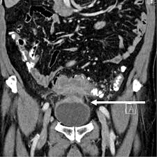 Ct scans are sometimes referred to as cat scans or computed tomography scans. Imaging Of Colorectal Cancer The Clue To Individualized Treatment