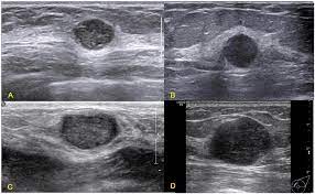 Finding breast lumps and seeing change in the size and shape. Triple Negative Invasive Breast Carcinoma The Association Between The Sonographic Appearances With Clinicopathological Feature Scientific Reports