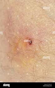 Image result for infected tick bite