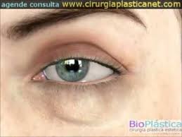 blefaroplastia cirurgia palpebras 3d blefaroplastia cirurgia palpebras palpebras blefaroplastia