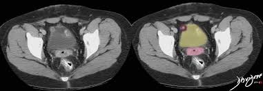 It causes tissue that looks and acts like endometrial tissue to implant outside the uterus. Endometriosis Of The Bladder On Ct Scan Art In Anatomy