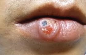 Image result for syphilis ulcer